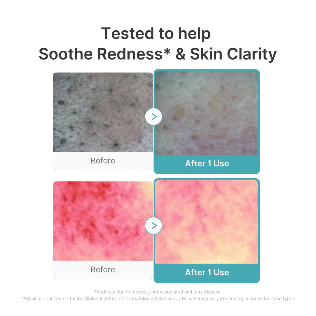 Azelaic Acid Capsule Foam Cleanser V6